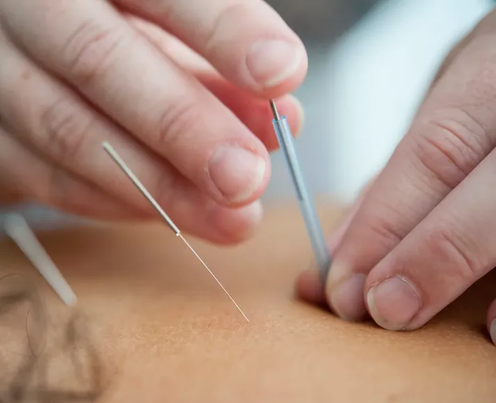 A serene spa setting featuring needles for a therapeutic acupuncture treatment